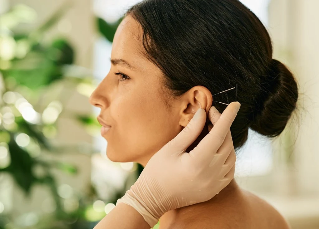 Auricular acupuncture — fine needles placed on ear points